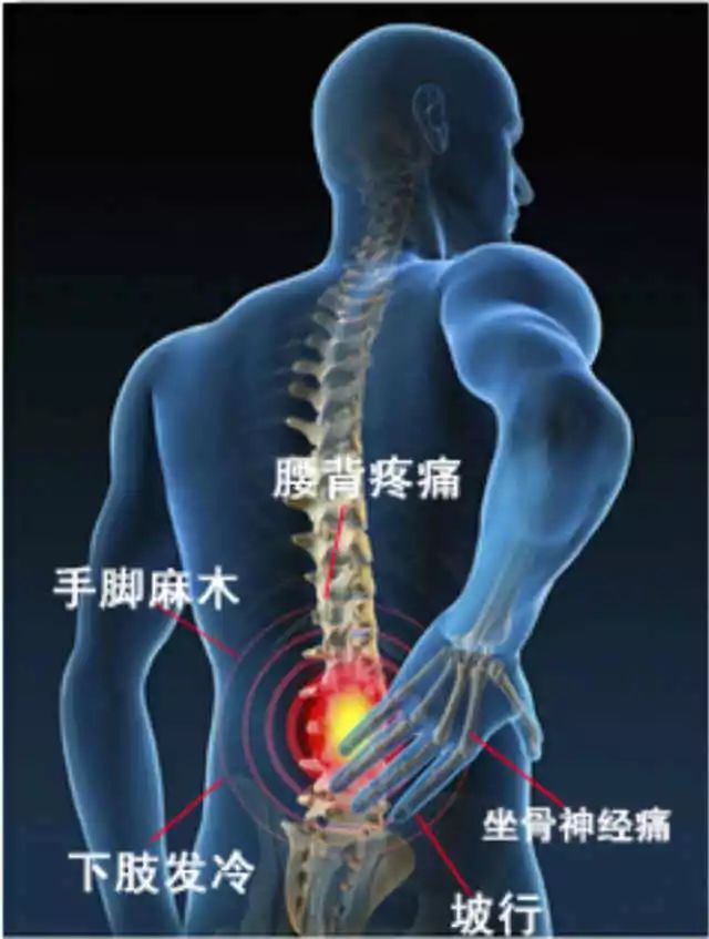 腰间盘突出最新疗法研究与应用进展