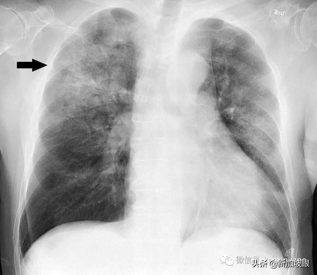 全球肺炎最新调查，现状、挑战与未来展望