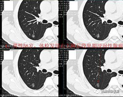 最新整形优惠，美丽新风尚一探究竟